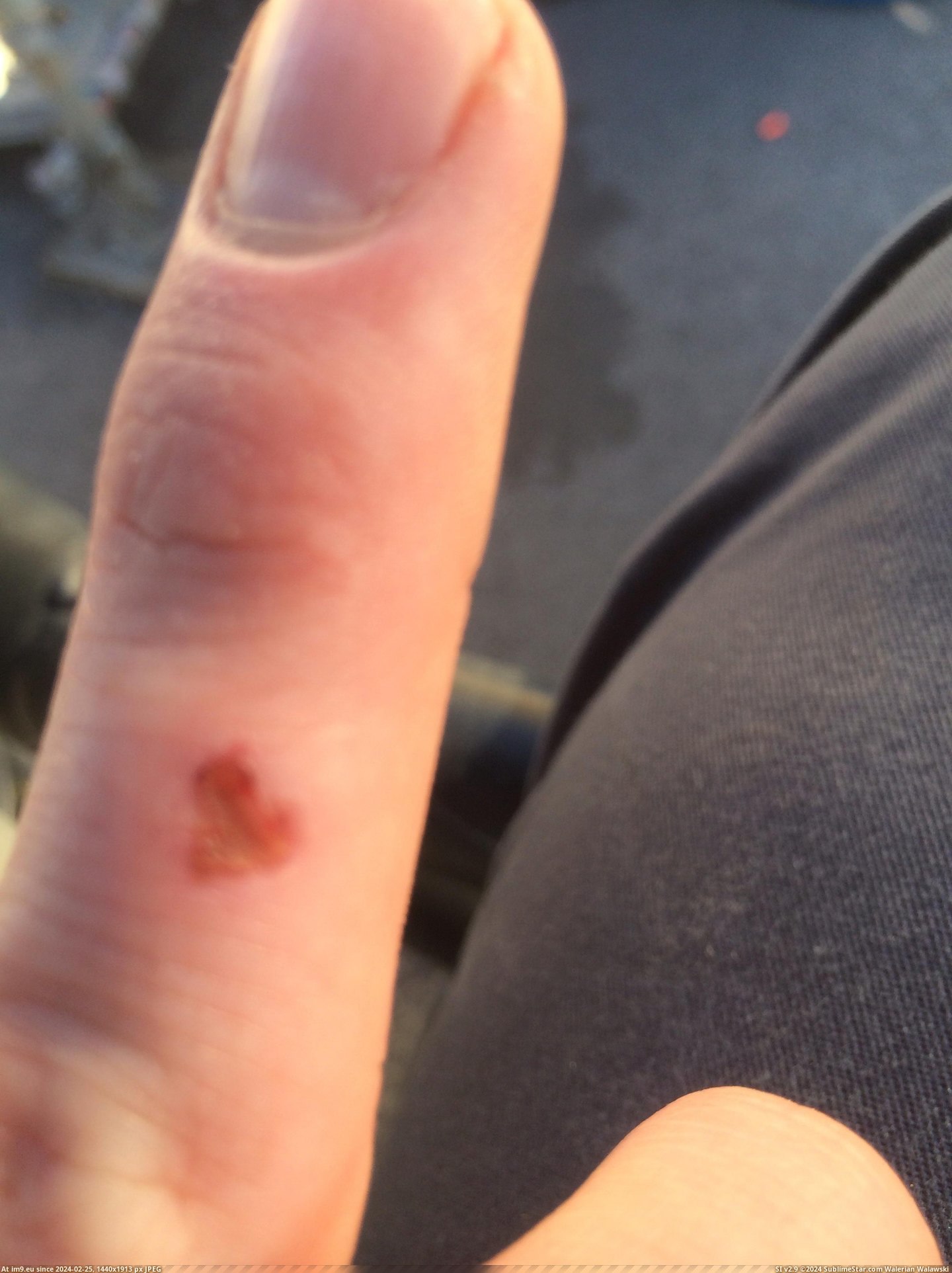 #Finger #Kind #Scab #Heart [Mildlyinteresting] My finger scab looks kind of like a heart. Pic. (Изображение из альбом My r/MILDLYINTERESTING favs))