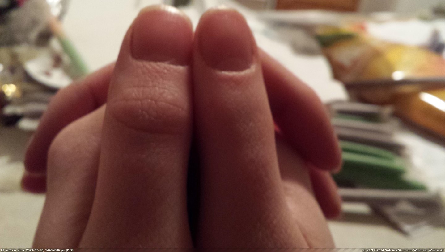 #Was #She #Can #Notice #Lack #Condition #Wrinkles #Thumb #Born #Bend [Mildlyinteresting] My GF was born with a condition where she can't bend her right thumb. Notice the lack of wrinkles. Pic. (Bild von album My r/MILDLYINTERESTING favs))