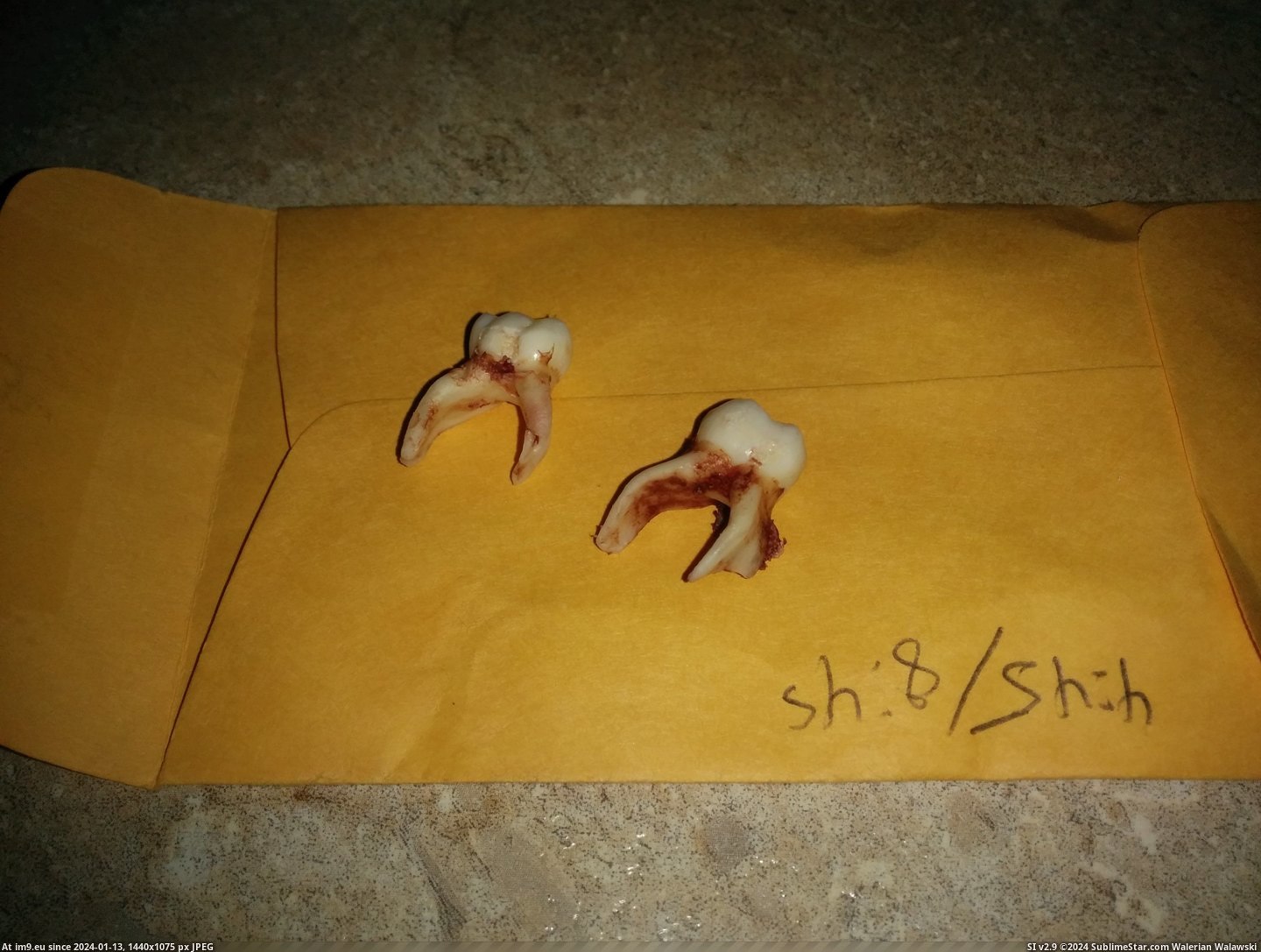 #Wtf #Baby #Mouth #Roots #Dentist #Cousins #Biggest #Pulled #Teeth [Wtf] Baby teeth pulled from my cousins mouth. Dentist said they were the biggest roots he's ever seen. Pic. (Image of album My r/WTF favs))