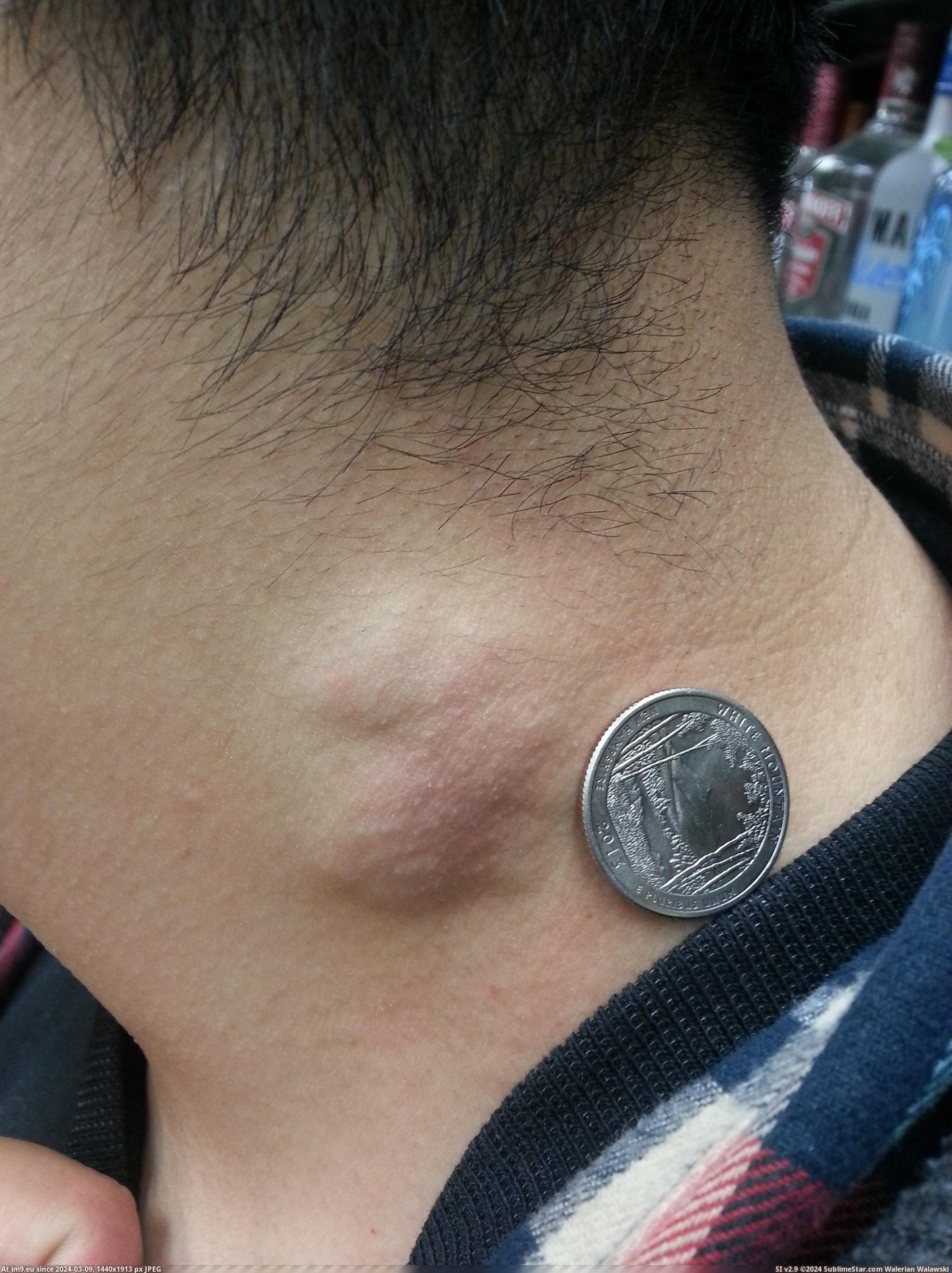 #Funny #Wtf #For #Happened #Banana #Quarter #Neck #Size #Feels #Hour #Worker [Wtf] Co-worker said my neck feels funny and an hour later this happened. Didn't have a banana so I used a quarter for size. Pic. (Изображение из альбом My r/WTF favs))