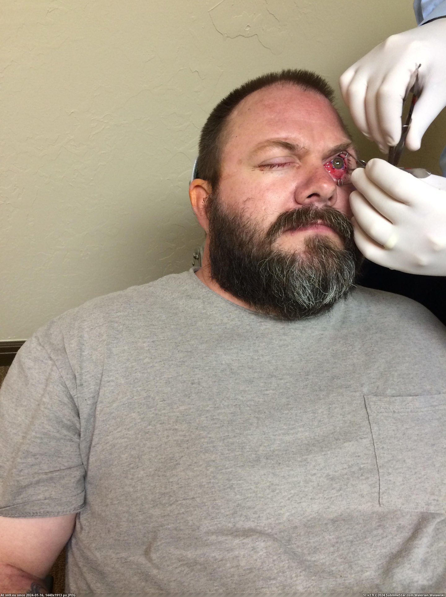 #Wtf #Surgery #Eye [Wtf] Had Eye Surgery Yesterday. 2 Pic. (Image of album My r/WTF favs))