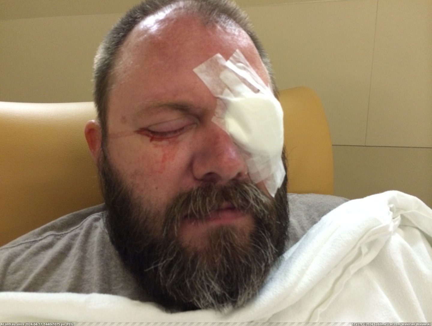 #Wtf #Surgery #Eye [Wtf] Had Eye Surgery Yesterday. 7 Pic. (Image of album My r/WTF favs))
