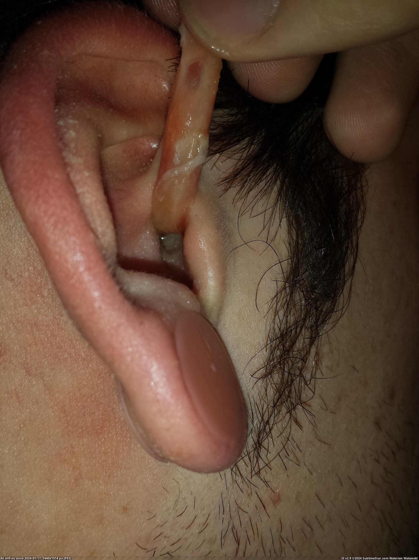 #Wtf #Ear #Infection #Crazy [Wtf] My crazy ear infection 1 Pic. (Image of album My r/WTF favs))