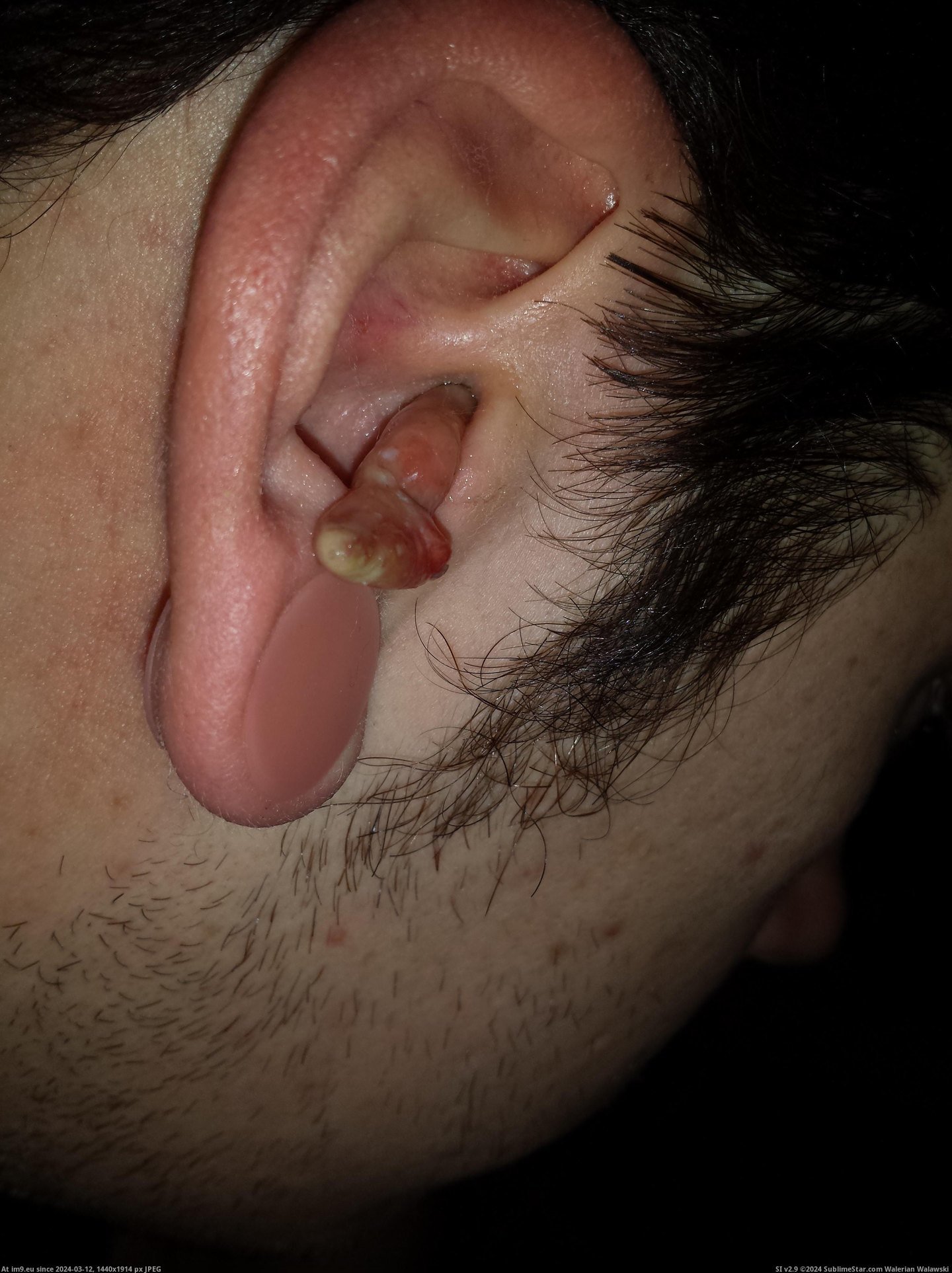 #Wtf #Ear #Infection #Crazy [Wtf] My crazy ear infection 11 Pic. (Image of album My r/WTF favs))