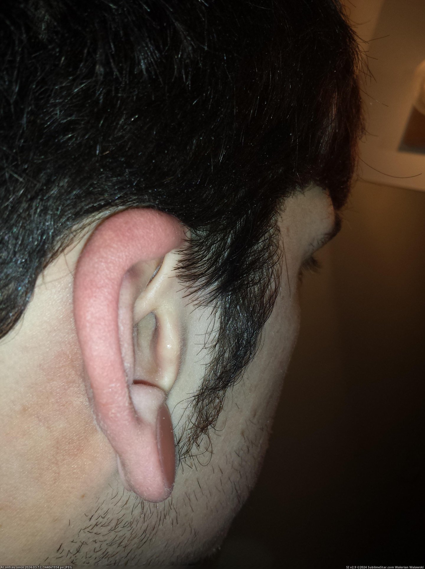 #Wtf #Ear #Infection #Crazy [Wtf] My crazy ear infection 12 Pic. (Obraz z album My r/WTF favs))