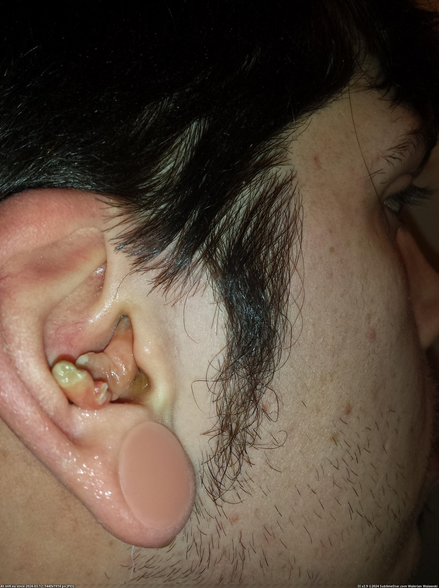 #Wtf #Ear #Infection #Crazy [Wtf] My crazy ear infection 13 Pic. (Bild von album My r/WTF favs))