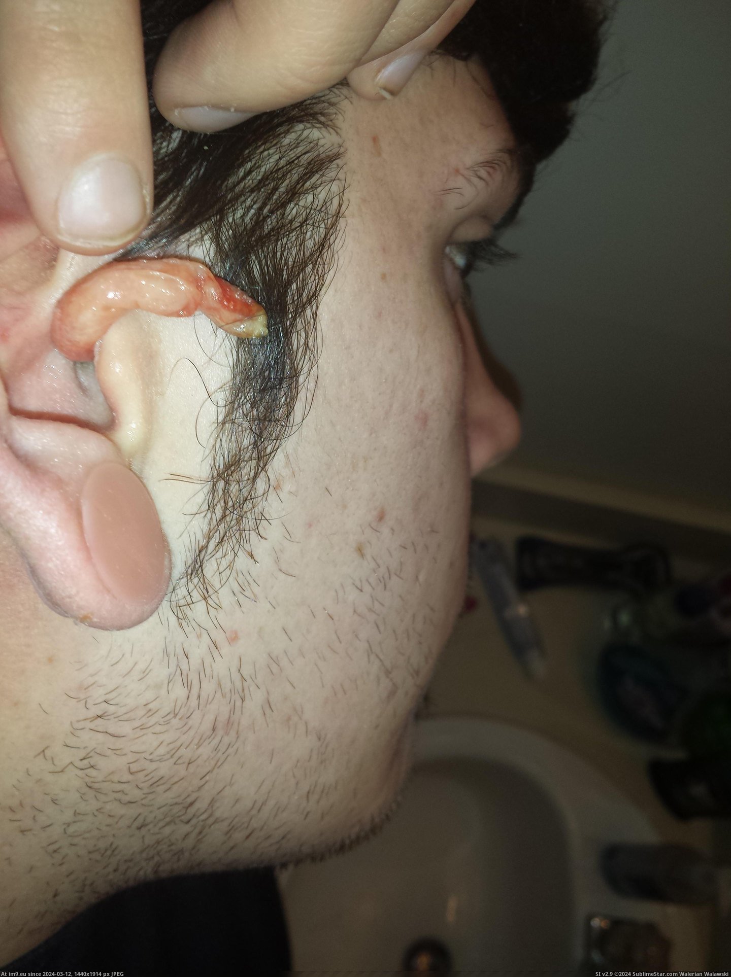 #Wtf #Ear #Infection #Crazy [Wtf] My crazy ear infection 14 Pic. (Изображение из альбом My r/WTF favs))