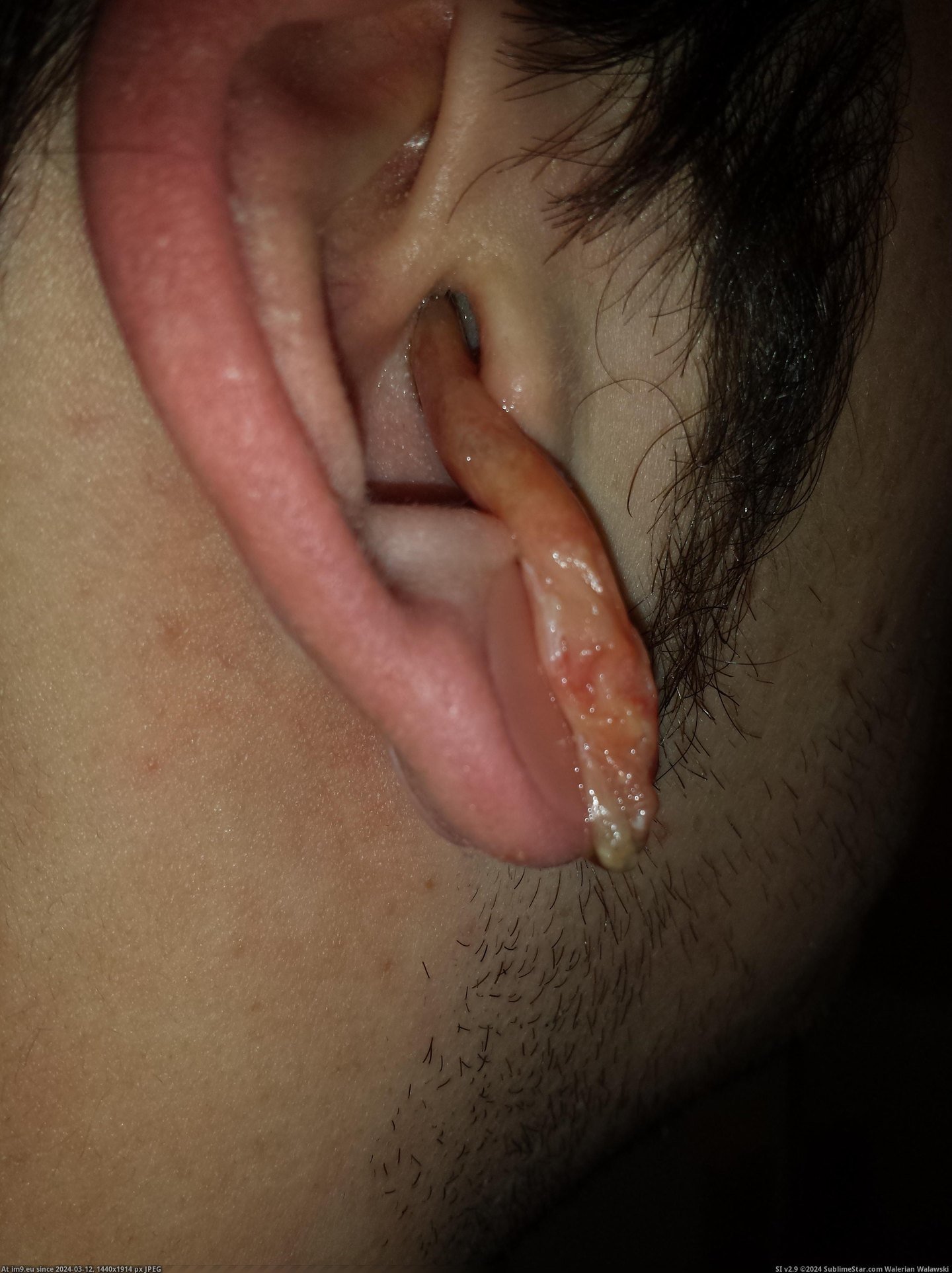 #Wtf #Ear #Infection #Crazy [Wtf] My crazy ear infection 2 Pic. (Obraz z album My r/WTF favs))
