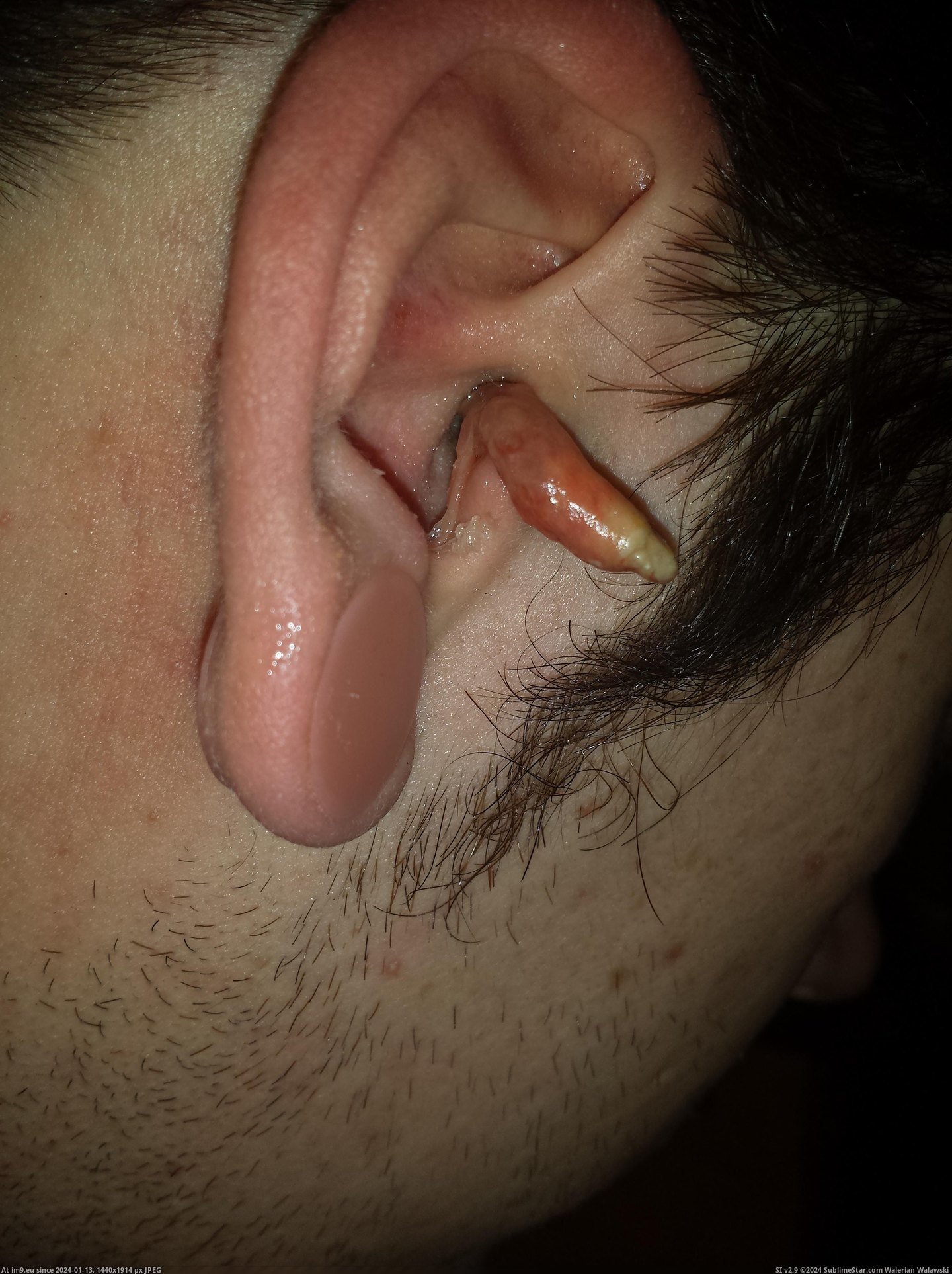 #Wtf #Ear #Infection #Crazy [Wtf] My crazy ear infection 3 Pic. (Obraz z album My r/WTF favs))