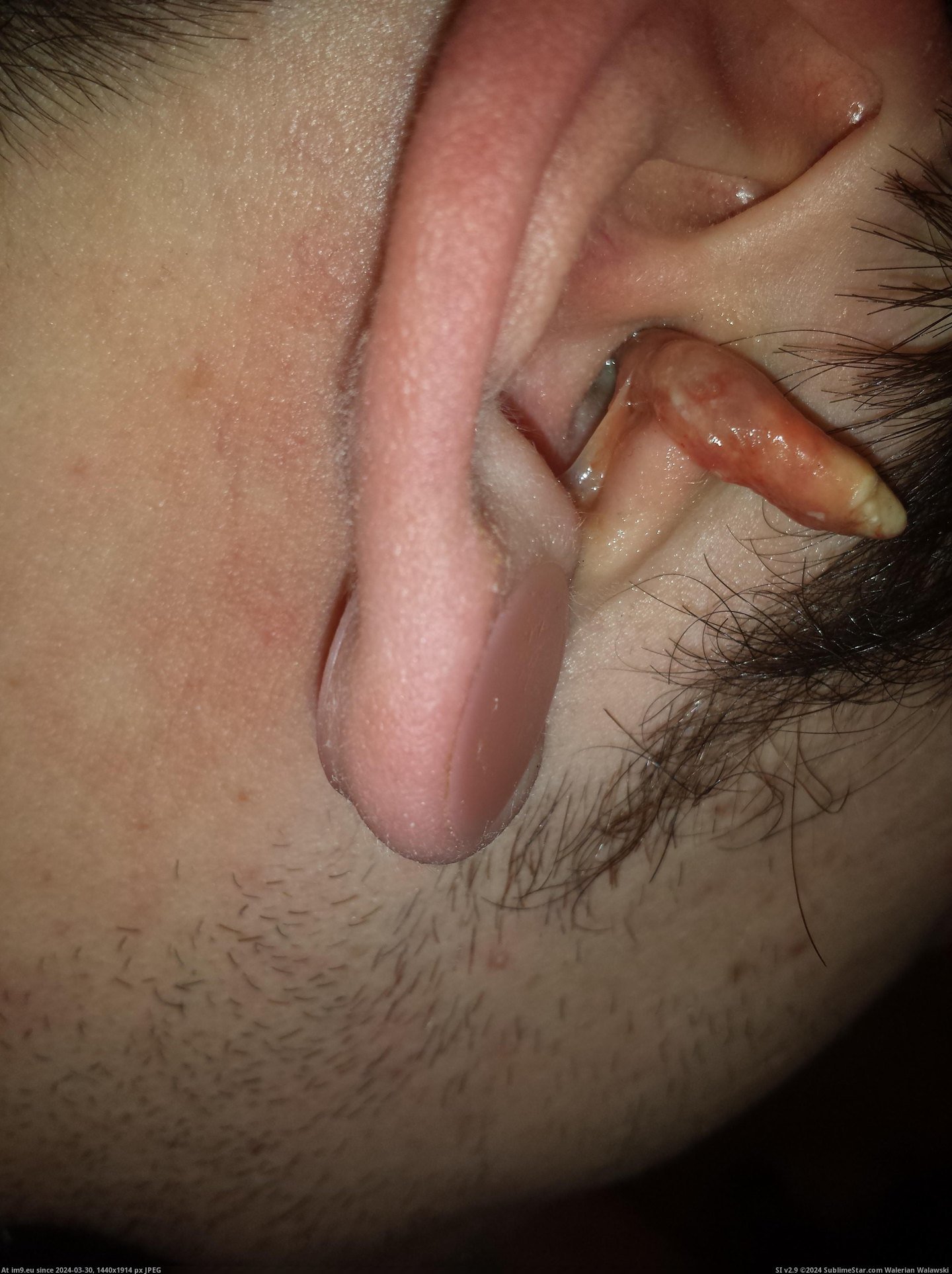 #Wtf #Ear #Infection #Crazy [Wtf] My crazy ear infection 6 Pic. (Bild von album My r/WTF favs))