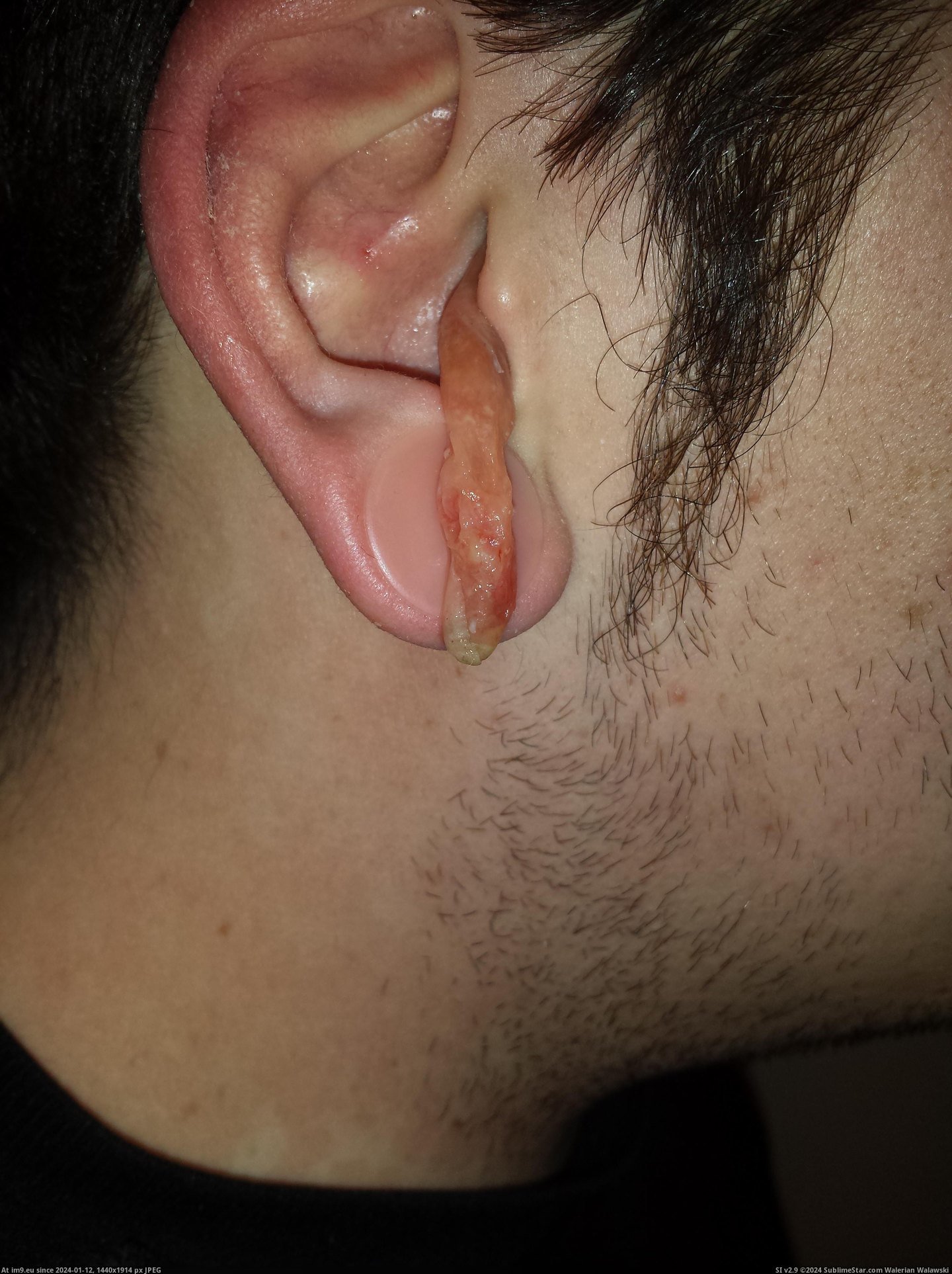 #Wtf #Ear #Infection #Crazy [Wtf] My crazy ear infection 8 Pic. (Image of album My r/WTF favs))