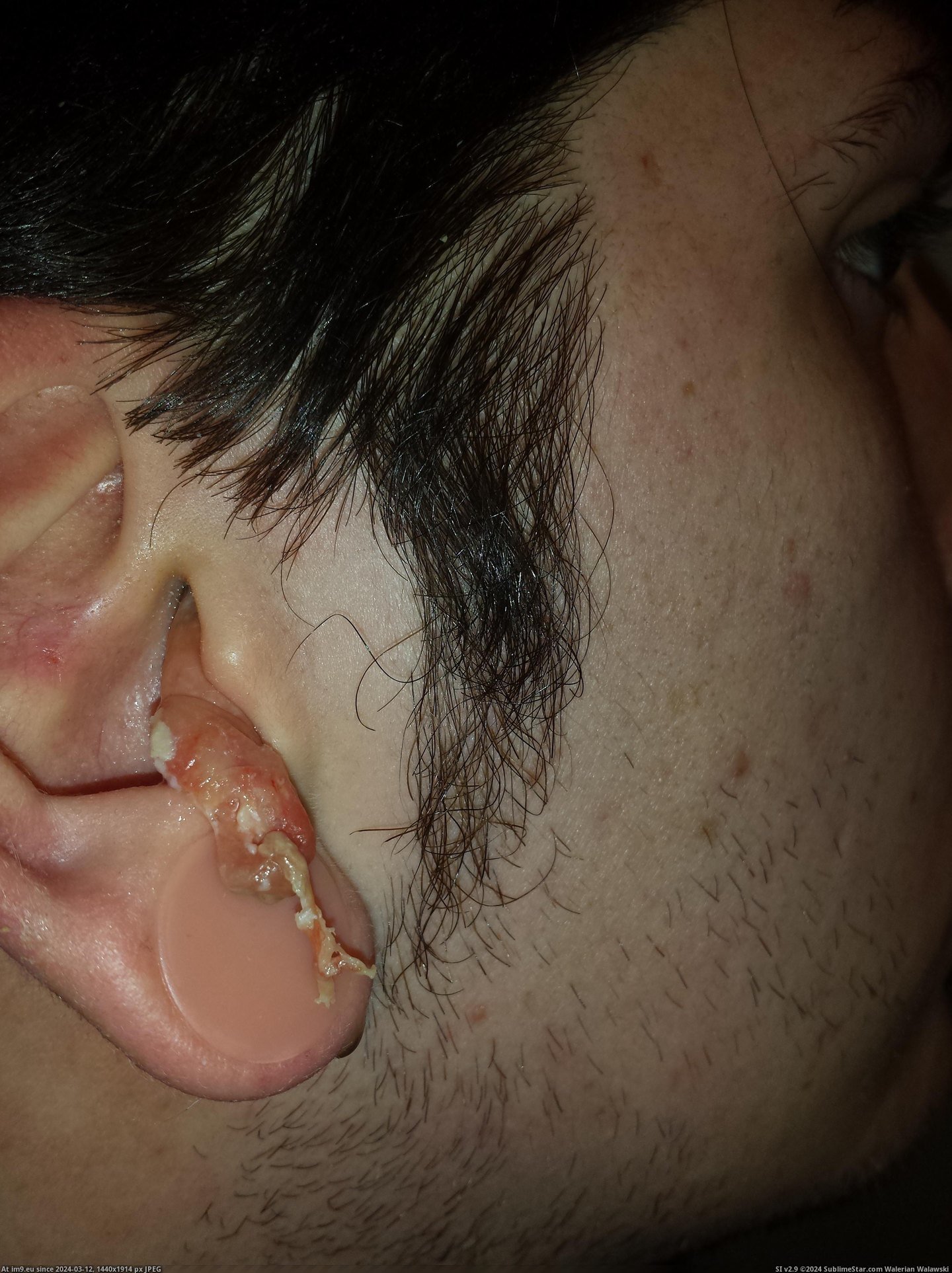 #Wtf #Ear #Infection #Crazy [Wtf] My crazy ear infection 9 Pic. (Obraz z album My r/WTF favs))