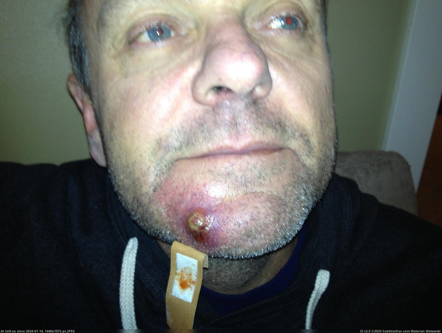#Wtf #Dad #Ingrown #Whisker #Infection #Staff [Wtf] My dad's ingrown whisker + staff infection Pic. (Obraz z album My r/WTF favs))