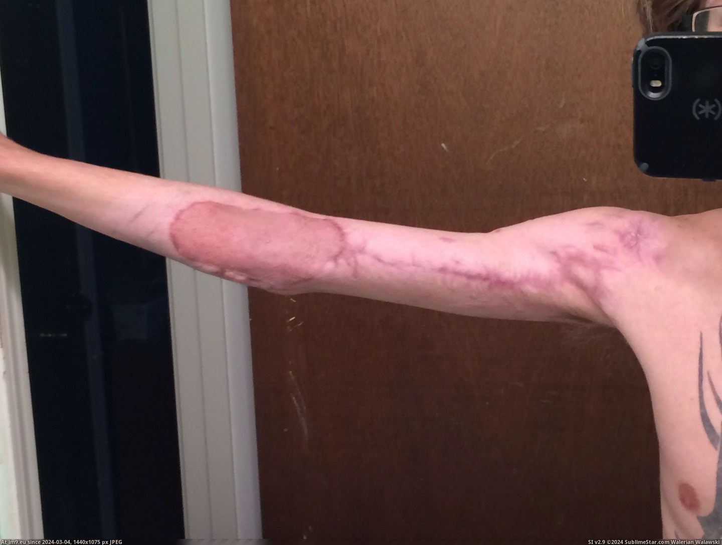 #Wtf #Day #Car #Arm #Wreck #Months #Left #Happened [Wtf] My left arm after a car wreck. From the day it happened until now, 6 months later 9 Pic. (Obraz z album My r/WTF favs))