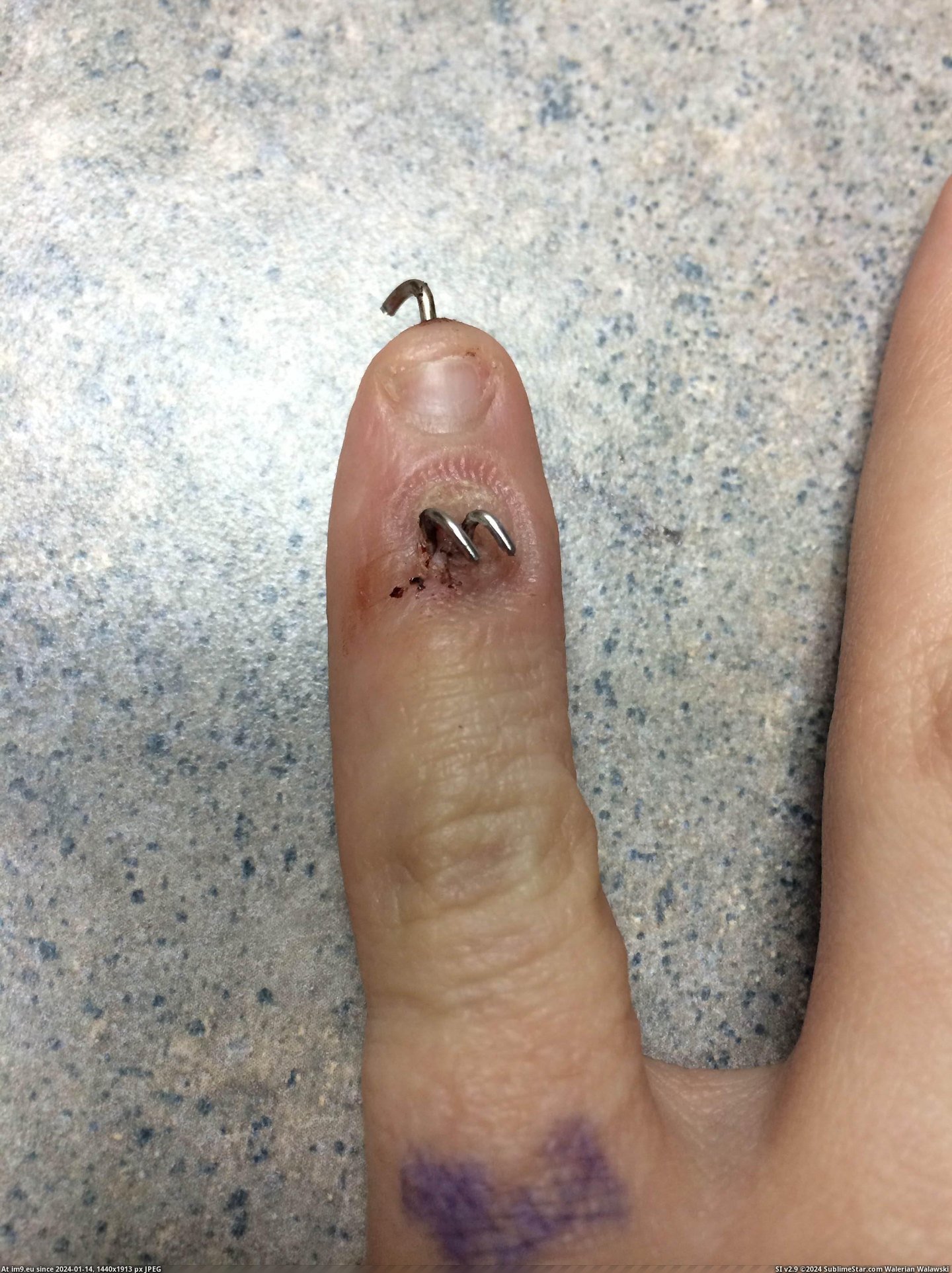 #Wtf #Wife #Pinky #Finger #Broken [Wtf] My Wife's Broken Pinky Finger 3 Pic. (Obraz z album My r/WTF favs))