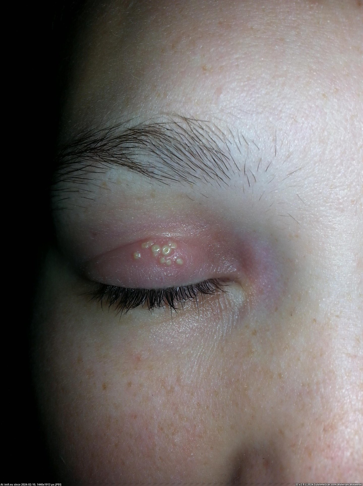 #Wtf #Woke #Eyelid #Wife [Wtf] My wife woke up with this on her eyelid. Wtf is it? Pic. (Bild von album My r/WTF favs))
