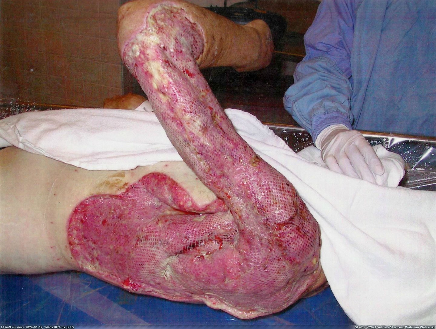 #Wtf #Was #Friend #Eating #Mother #Bad #Fasciitis #Necrotizing #Flesh #Disease [Wtf] Necrotizing Fasciitis (Flesh Eating Disease). My friend's mother was infected by a bad batch of heroin that was smuggled i Pic. (Image of album My r/WTF favs))