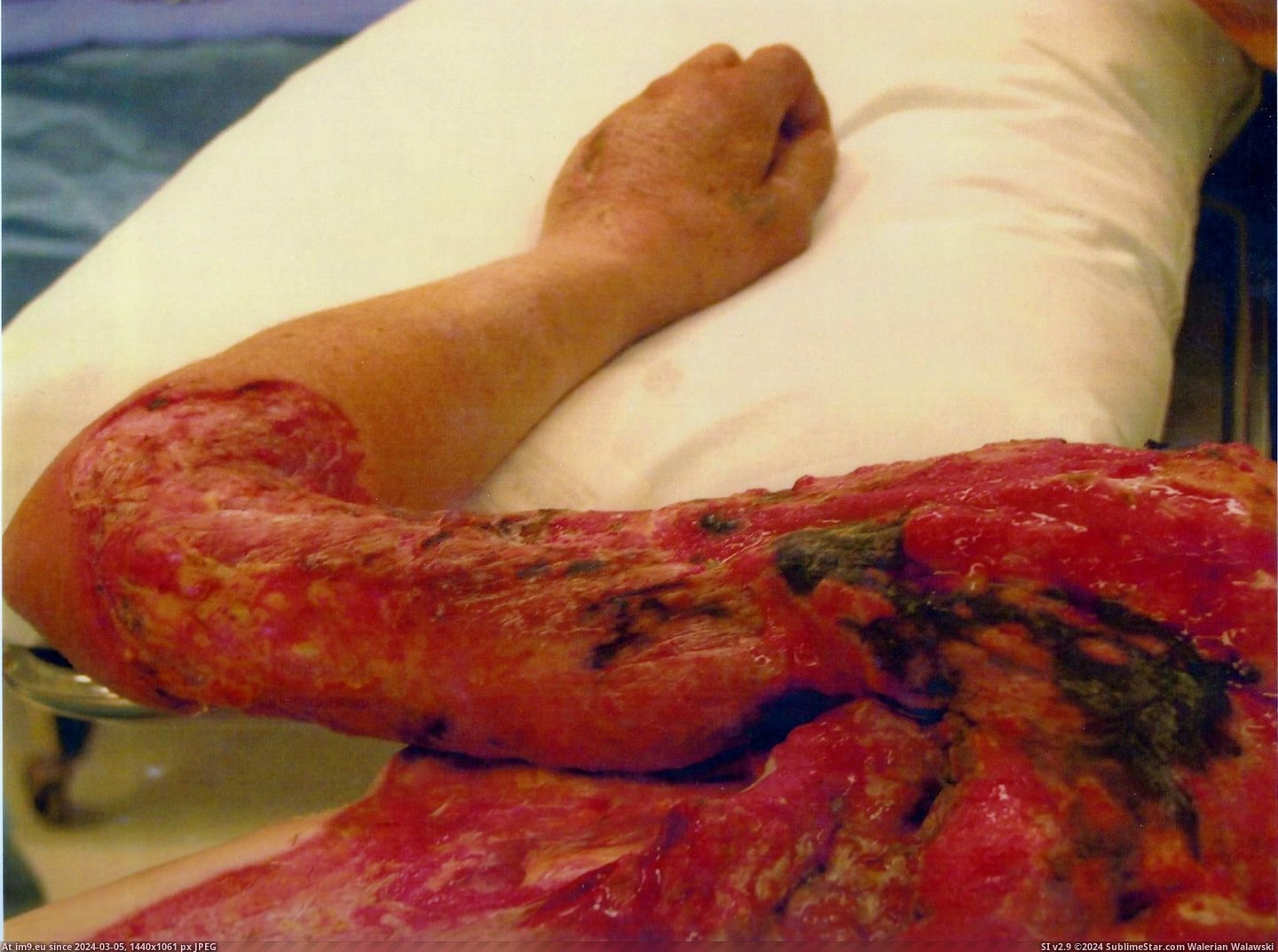 #Wtf #Was #Friend #Eating #Mother #Bad #Fasciitis #Necrotizing #Flesh #Disease [Wtf] Necrotizing Fasciitis (Flesh Eating Disease). My friend's mother was infected by a bad batch of heroin that was smuggled i Pic. (Obraz z album My r/WTF favs))