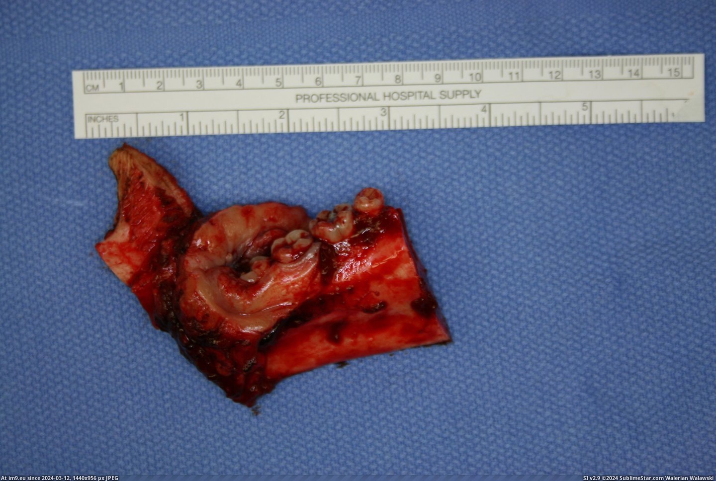 #Wtf #Surgery #Cancer #Oral [Wtf] Oral Cancer Surgery 1 Pic. (Image of album My r/WTF favs))