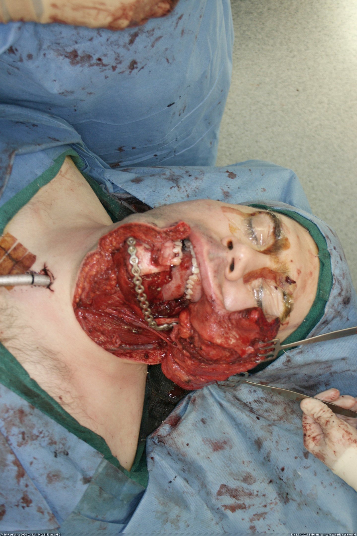 #Wtf #Surgery #Cancer #Oral [Wtf] Oral Cancer Surgery 3 Pic. (Image of album My r/WTF favs))