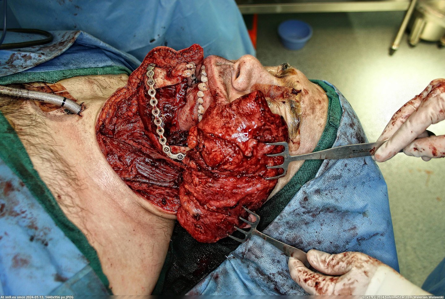 #Wtf #Surgery #Cancer #Oral [Wtf] Oral Cancer Surgery 6 Pic. (Image of album My r/WTF favs))