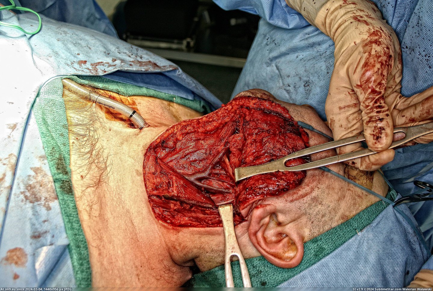 #Wtf #Surgery #Cancer #Oral [Wtf] Oral Cancer Surgery 7 Pic. (Image of album My r/WTF favs))