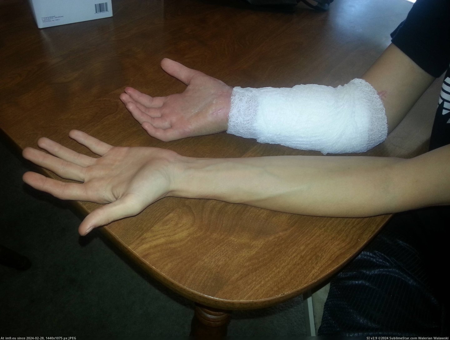 #Wtf #Photos #Guy #Lathe #Remeber #Arm #Ripped #Progress [Wtf] Remeber the guy whos arm got ripped off in a lathe? Well im back with photos on the progress. 1 Pic. (Image of album My r/WTF favs))