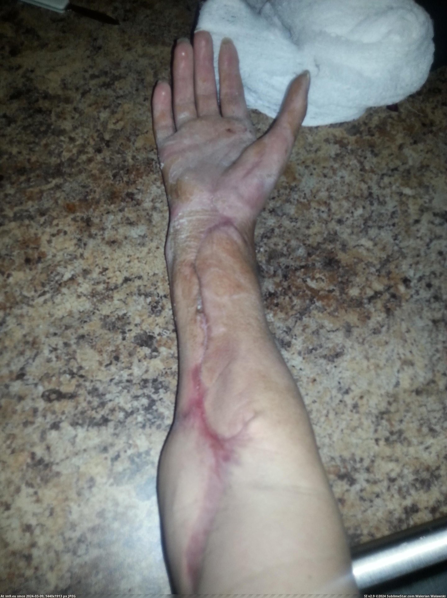 #Wtf #Photos #Guy #Lathe #Remeber #Arm #Ripped #Progress [Wtf] Remeber the guy whos arm got ripped off in a lathe? Well im back with photos on the progress. 3 Pic. (Image of album My r/WTF favs))