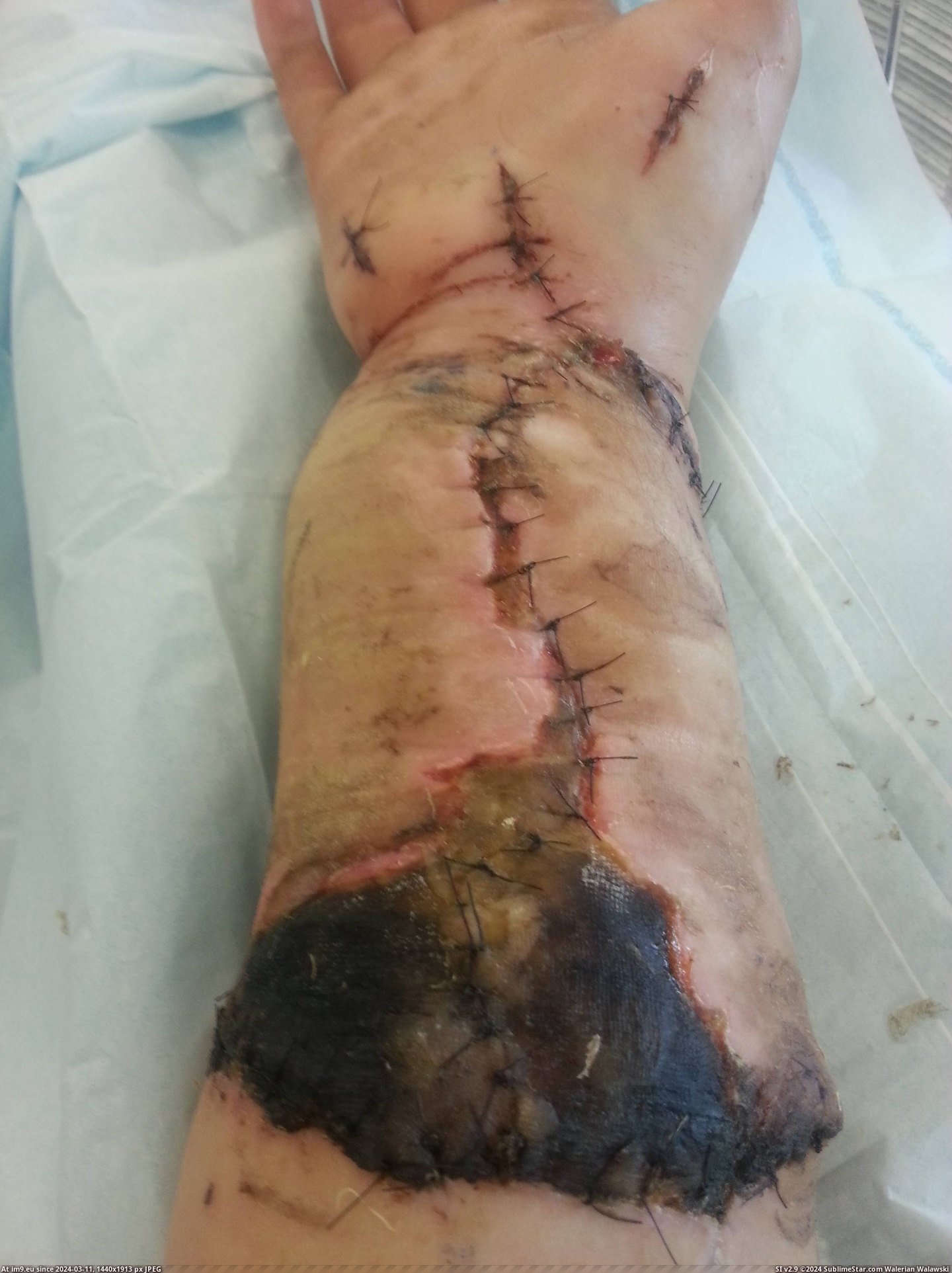 #Wtf #Photos #Guy #Lathe #Remeber #Arm #Ripped #Progress [Wtf] Remeber the guy whos arm got ripped off in a lathe? Well im back with photos on the progress. 4 Pic. (Image of album My r/WTF favs))