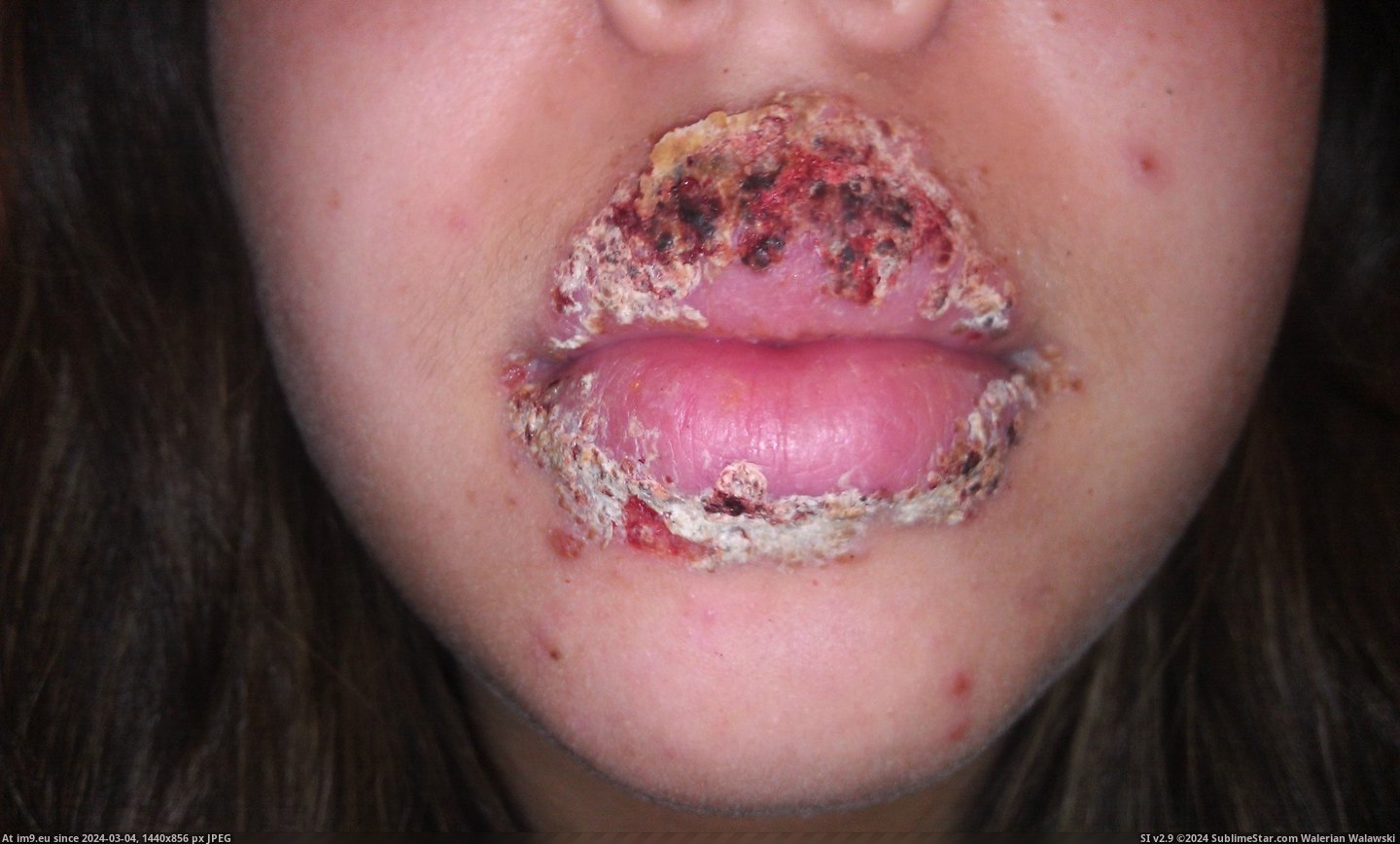 #Wtf #Face #Screw #Disorder #Sore #Cold #Weeks [Wtf] The Cold Sore(s) that took over my face for 2 weeks. [NSFW] Don't screw with an Autoimmune Disorder 10 Pic. (Bild von album My r/WTF favs))