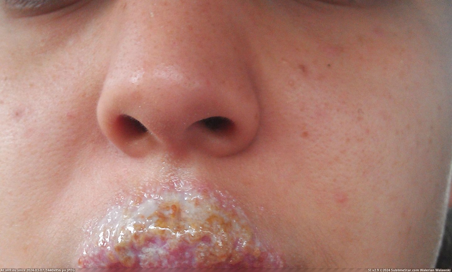 #Wtf #Face #Screw #Disorder #Sore #Cold #Weeks [Wtf] The Cold Sore(s) that took over my face for 2 weeks. [NSFW] Don't screw with an Autoimmune Disorder 2 Pic. (Image of album My r/WTF favs))