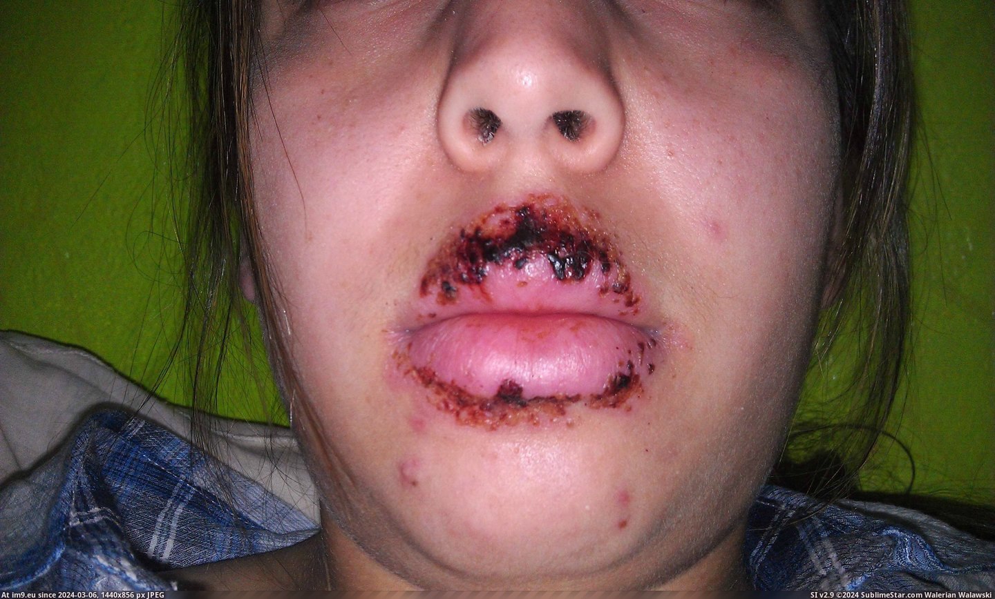 #Wtf #Face #Screw #Disorder #Sore #Cold #Weeks [Wtf] The Cold Sore(s) that took over my face for 2 weeks. [NSFW] Don't screw with an Autoimmune Disorder 5 Pic. (Image of album My r/WTF favs))