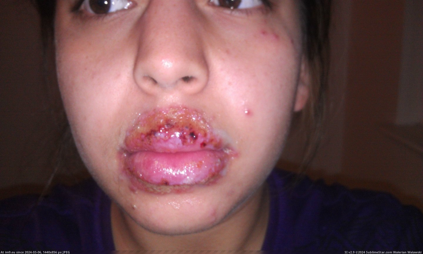 #Wtf #Face #Screw #Disorder #Sore #Cold #Weeks [Wtf] The Cold Sore(s) that took over my face for 2 weeks. [NSFW] Don't screw with an Autoimmune Disorder 6 Pic. (Obraz z album My r/WTF favs))