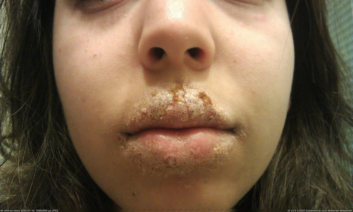 #Wtf #Face #Screw #Disorder #Sore #Cold #Weeks [Wtf] The Cold Sore(s) that took over my face for 2 weeks. [NSFW] Don't screw with an Autoimmune Disorder 7 Pic. (Obraz z album My r/WTF favs))
