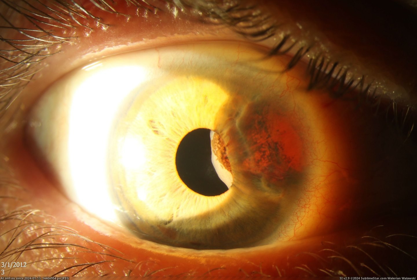 #Wtf #Was #Eye #Diameter #5mm #Treatments #Tumour #Nsfl #Cancer #Began [Wtf] This is my eye before I began cancer treatments. The tumour was about 5mm in diameter. (NSFL) Pic. (Image of album My r/WTF favs))