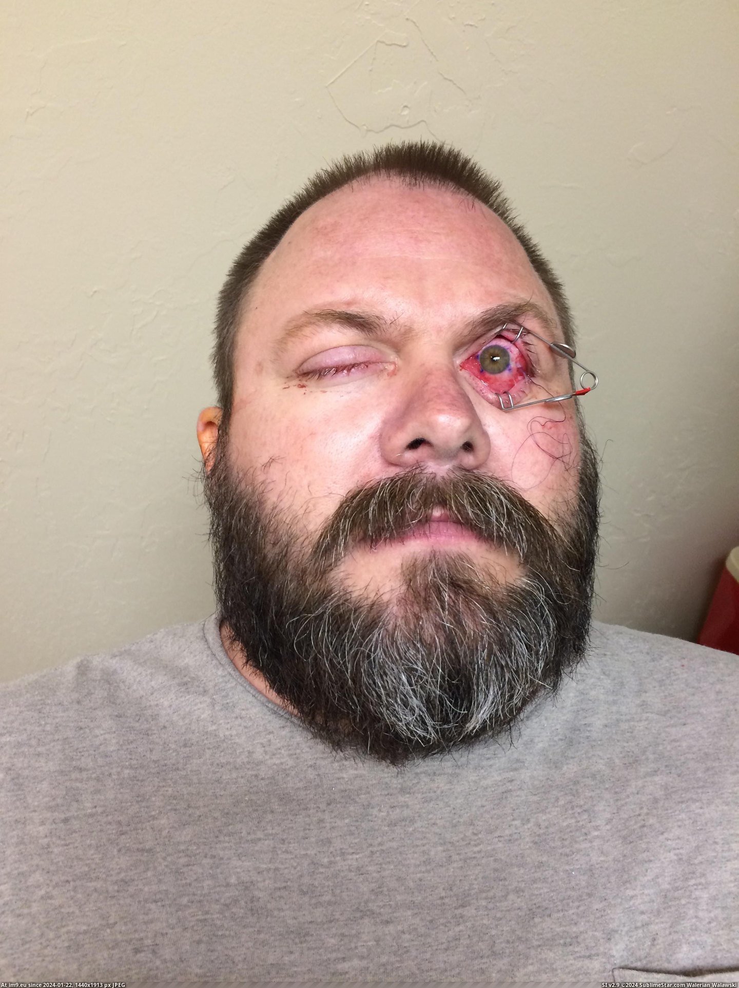 #Wtf #Surgery #Eye [Wtf] Had Eye Surgery Yesterday. 11 Pic. (Image of album My r/WTF favs))