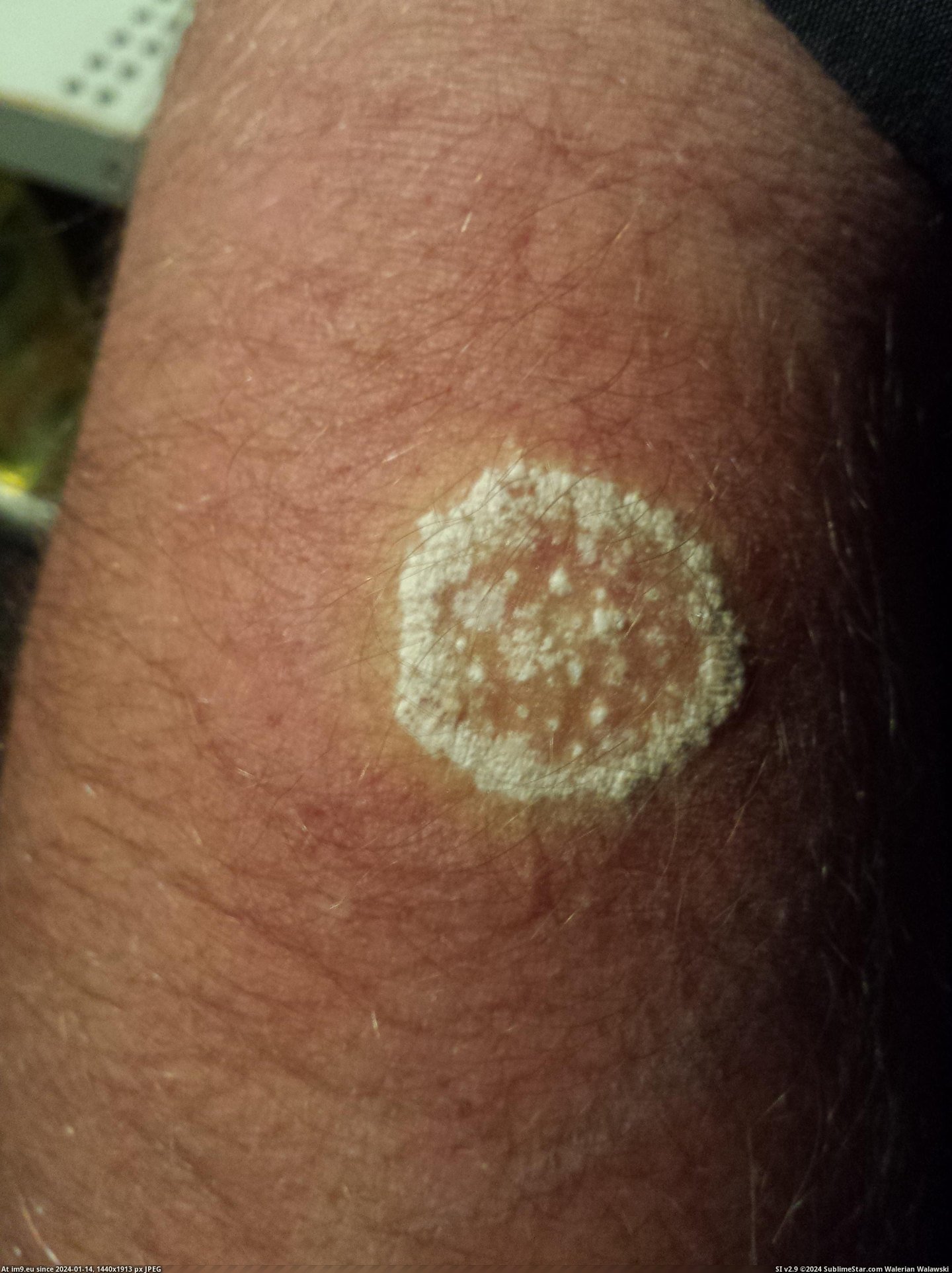 #Wtf #Put #Peroxide #Arm #Ringworm [Wtf] I put 35% peroxide on the ringworm on my arm Pic. (Image of album My r/WTF favs))