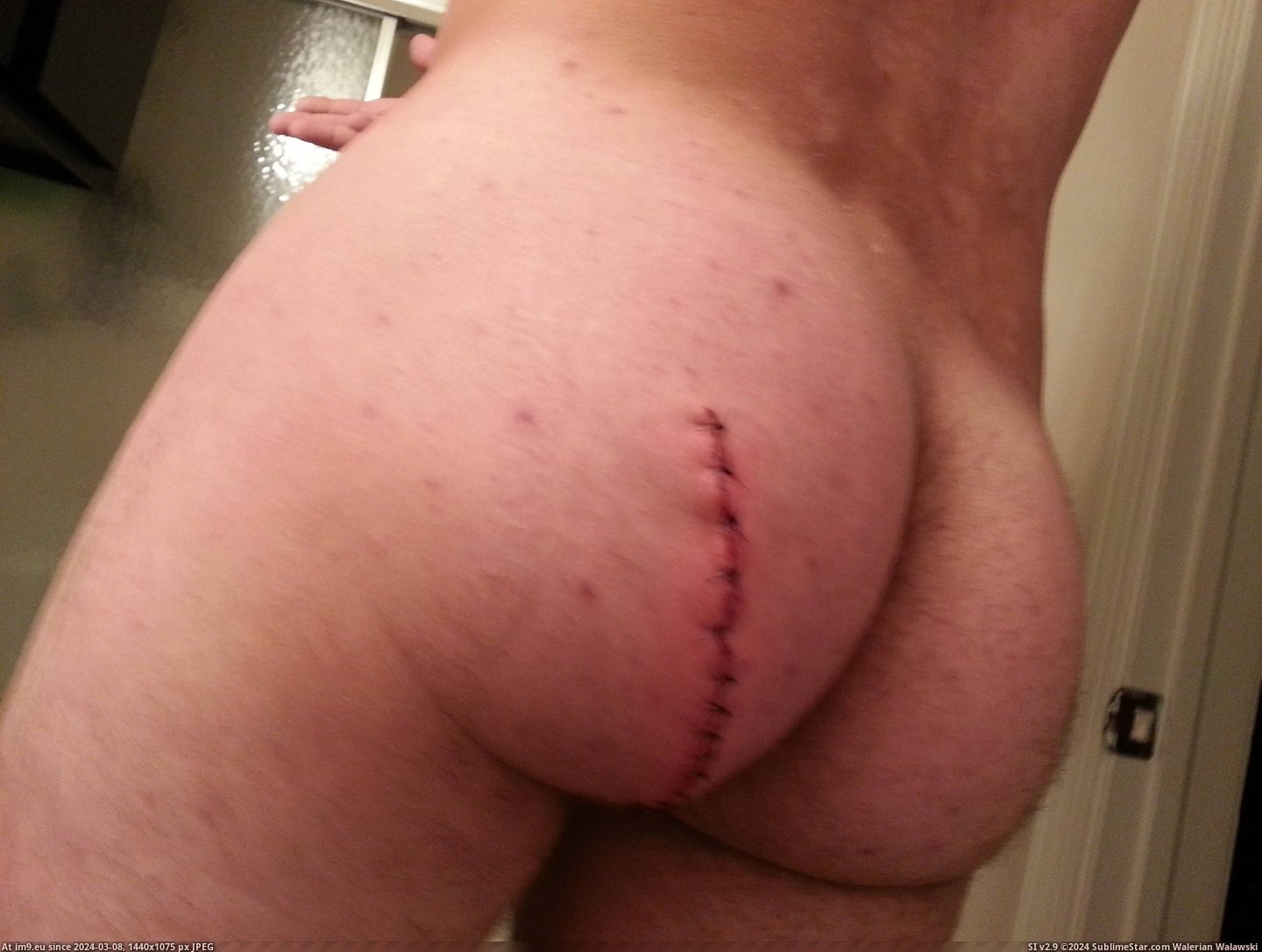 #Ass #Wtf #Got #Off #Ladder #Stepped #Latch #Piece #Caught #Door #Steel [Wtf] My ass got caught on a piece of steel on a door latch as I stepped off a ladder. 3 Pic. (Image of album My r/WTF favs))