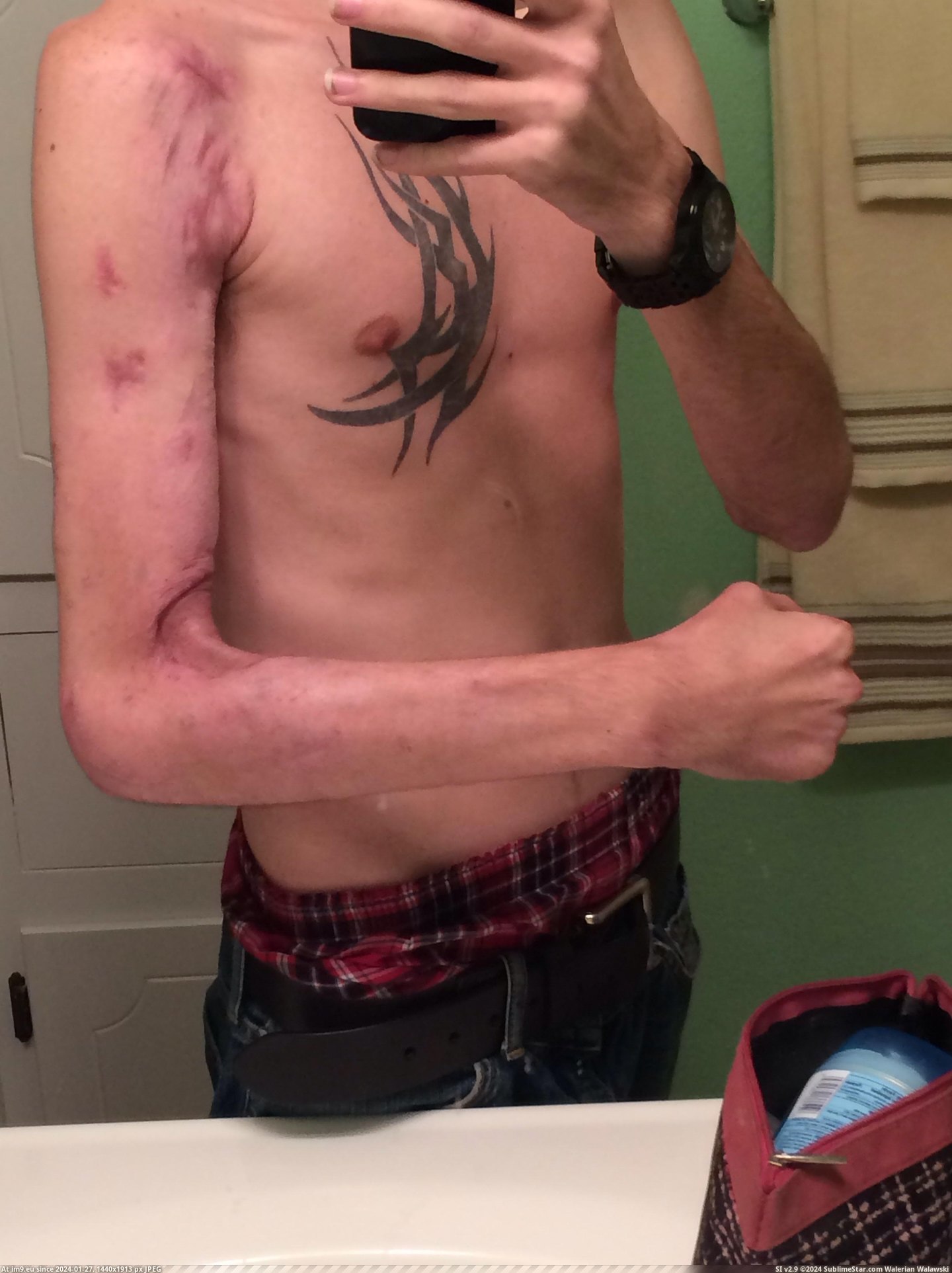 #Wtf #Day #Car #Arm #Wreck #Months #Left #Happened [Wtf] My left arm after a car wreck. From the day it happened until now, 6 months later 3 Pic. (Image of album My r/WTF favs))