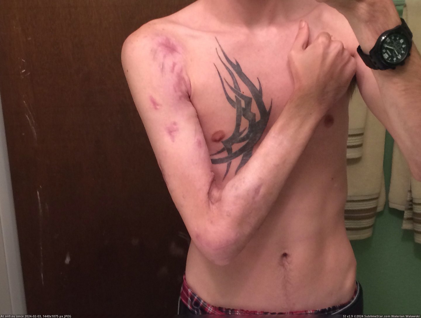 #Wtf #Day #Car #Arm #Wreck #Months #Left #Happened [Wtf] My left arm after a car wreck. From the day it happened until now, 6 months later 4 Pic. (Image of album My r/WTF favs))