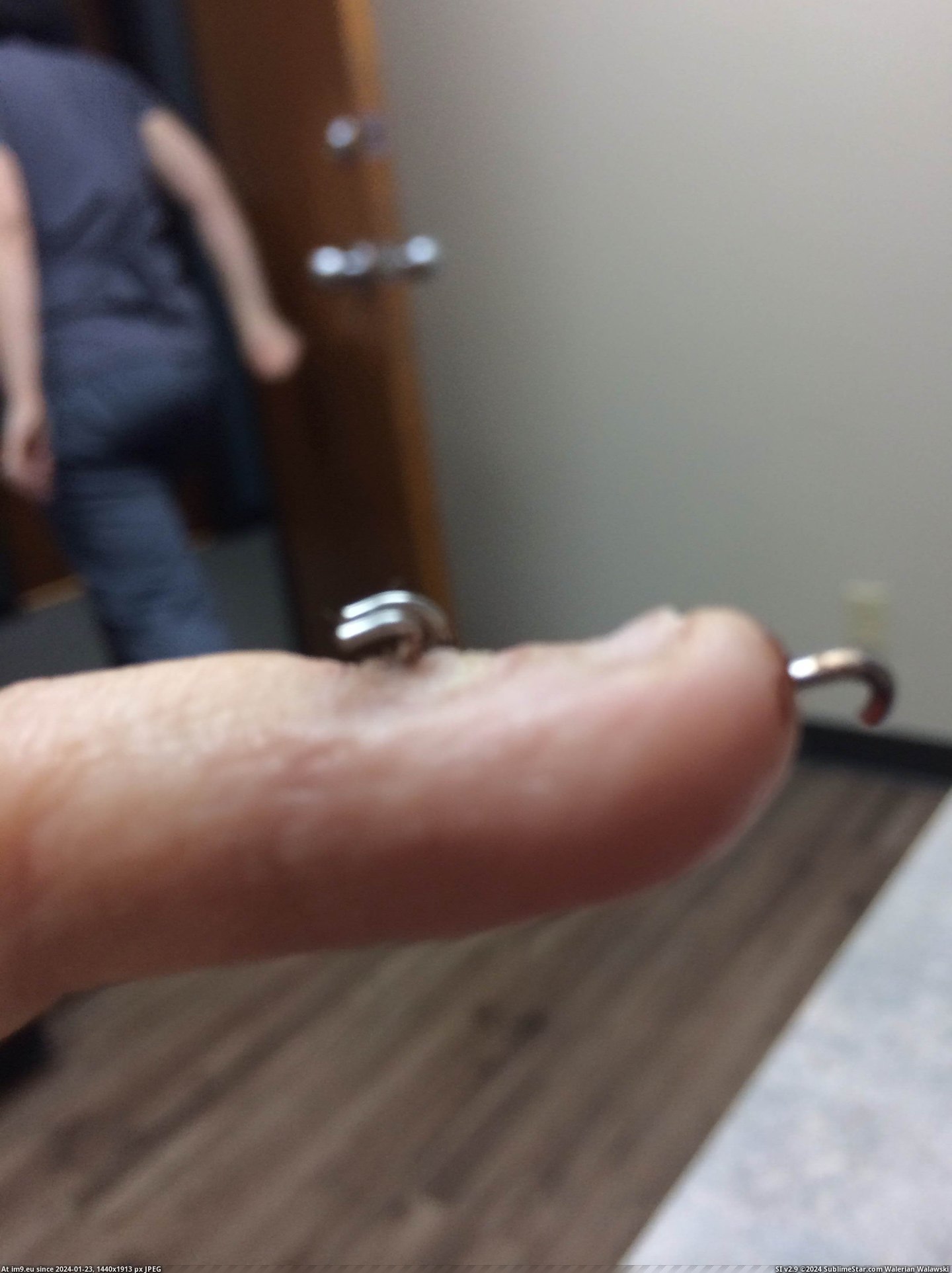 #Wtf #Wife #Pinky #Finger #Broken [Wtf] My Wife's Broken Pinky Finger 1 Pic. (Obraz z album My r/WTF favs))