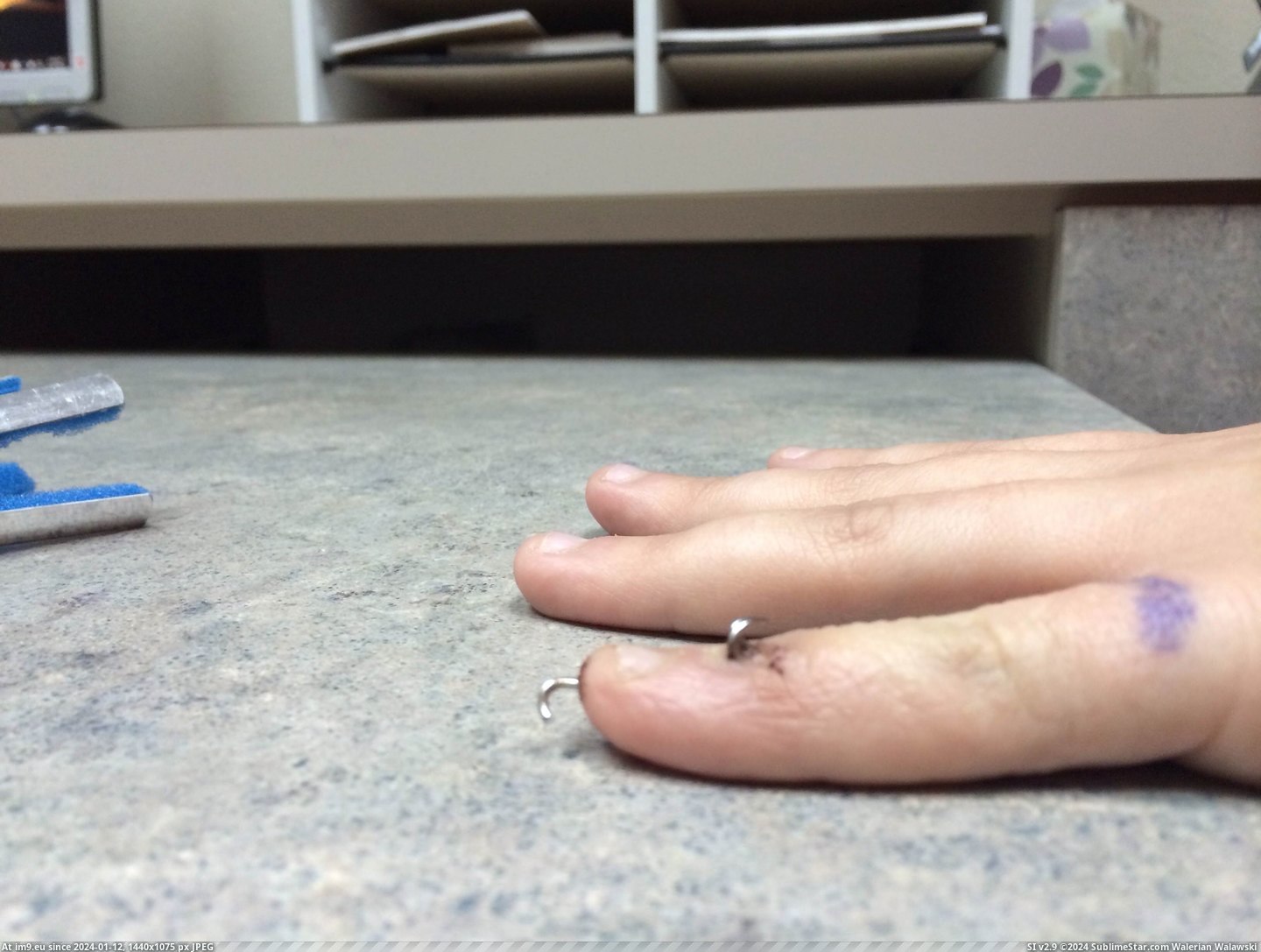#Wtf #Wife #Pinky #Finger #Broken [Wtf] My Wife's Broken Pinky Finger 4 Pic. (Изображение из альбом My r/WTF favs))