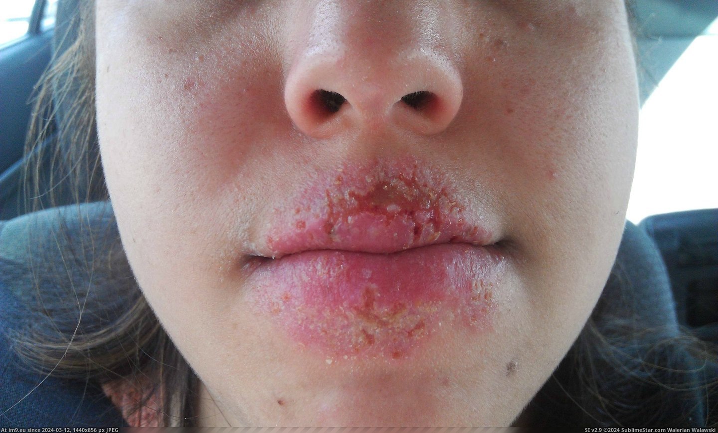 #Wtf #Face #Screw #Disorder #Sore #Cold #Weeks [Wtf] The Cold Sore(s) that took over my face for 2 weeks. [NSFW] Don't screw with an Autoimmune Disorder 11 Pic. (Image of album My r/WTF favs))