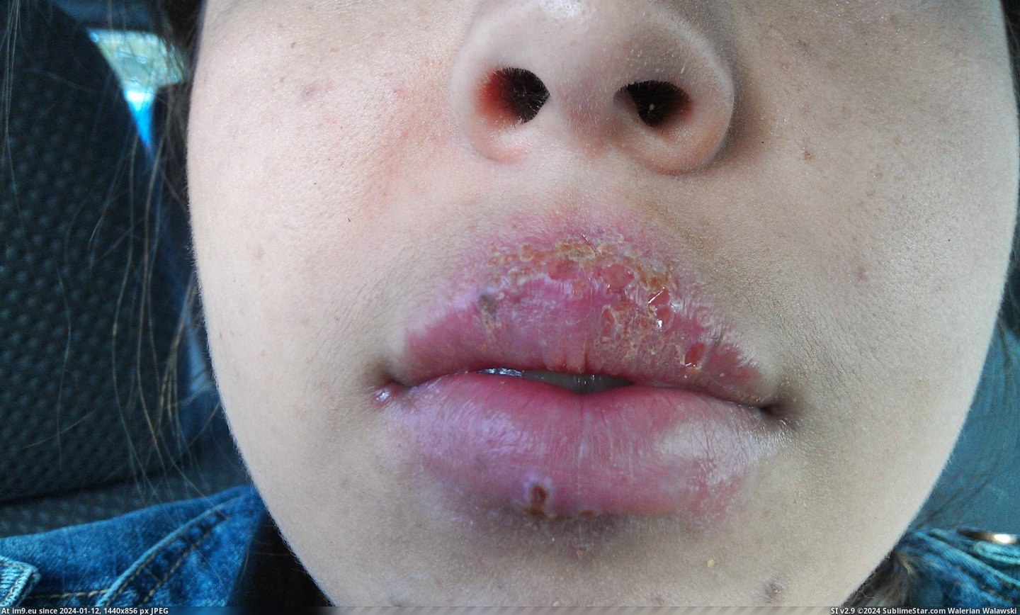#Wtf #Face #Screw #Disorder #Sore #Cold #Weeks [Wtf] The Cold Sore(s) that took over my face for 2 weeks. [NSFW] Don't screw with an Autoimmune Disorder 12 Pic. (Image of album My r/WTF favs))