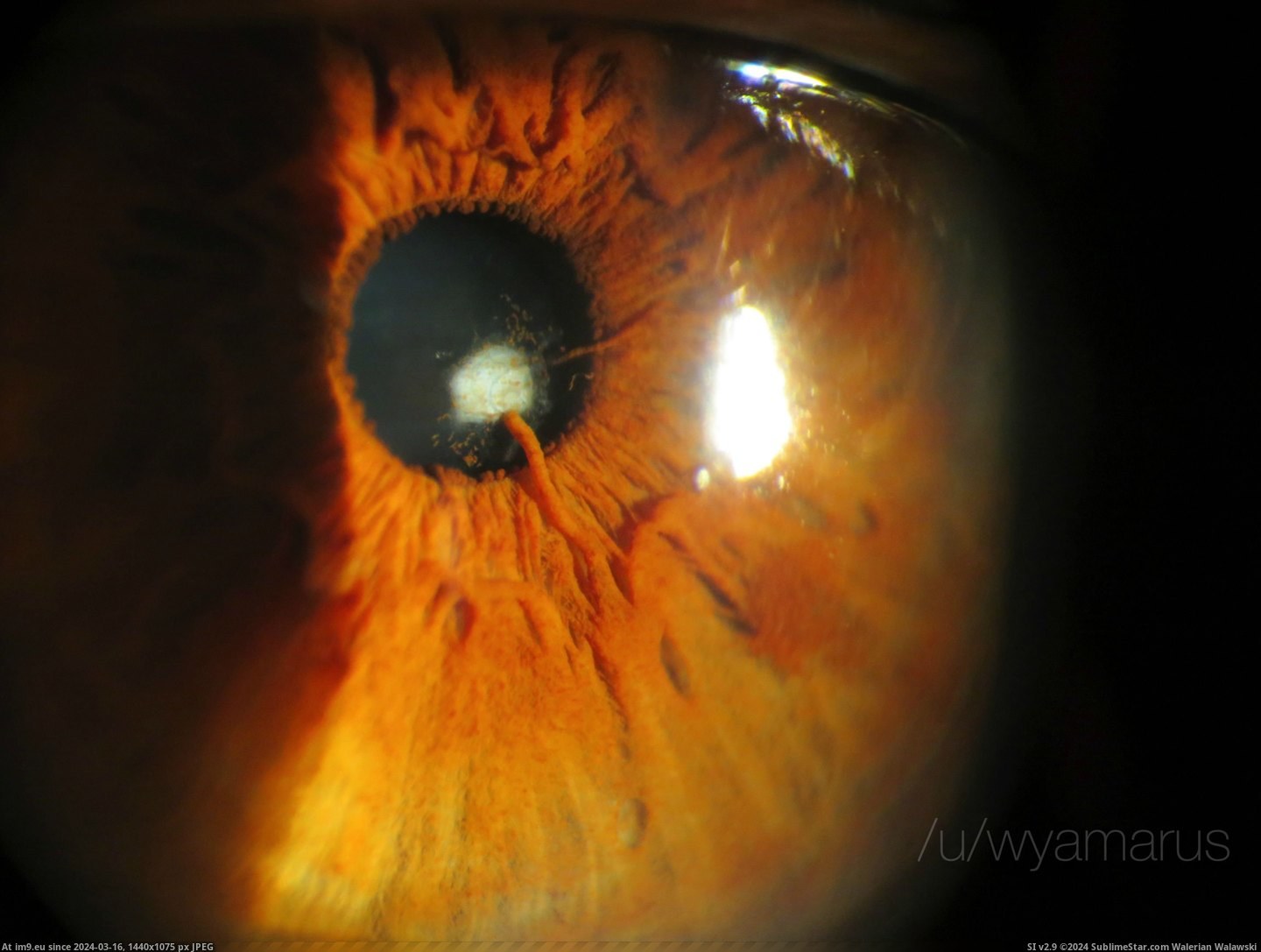 #Wtf #Eye #Lens #Growing #Iris [Wtf] This persons iris started growing into the lens of the eye. Pic. (Image of album My r/WTF favs))