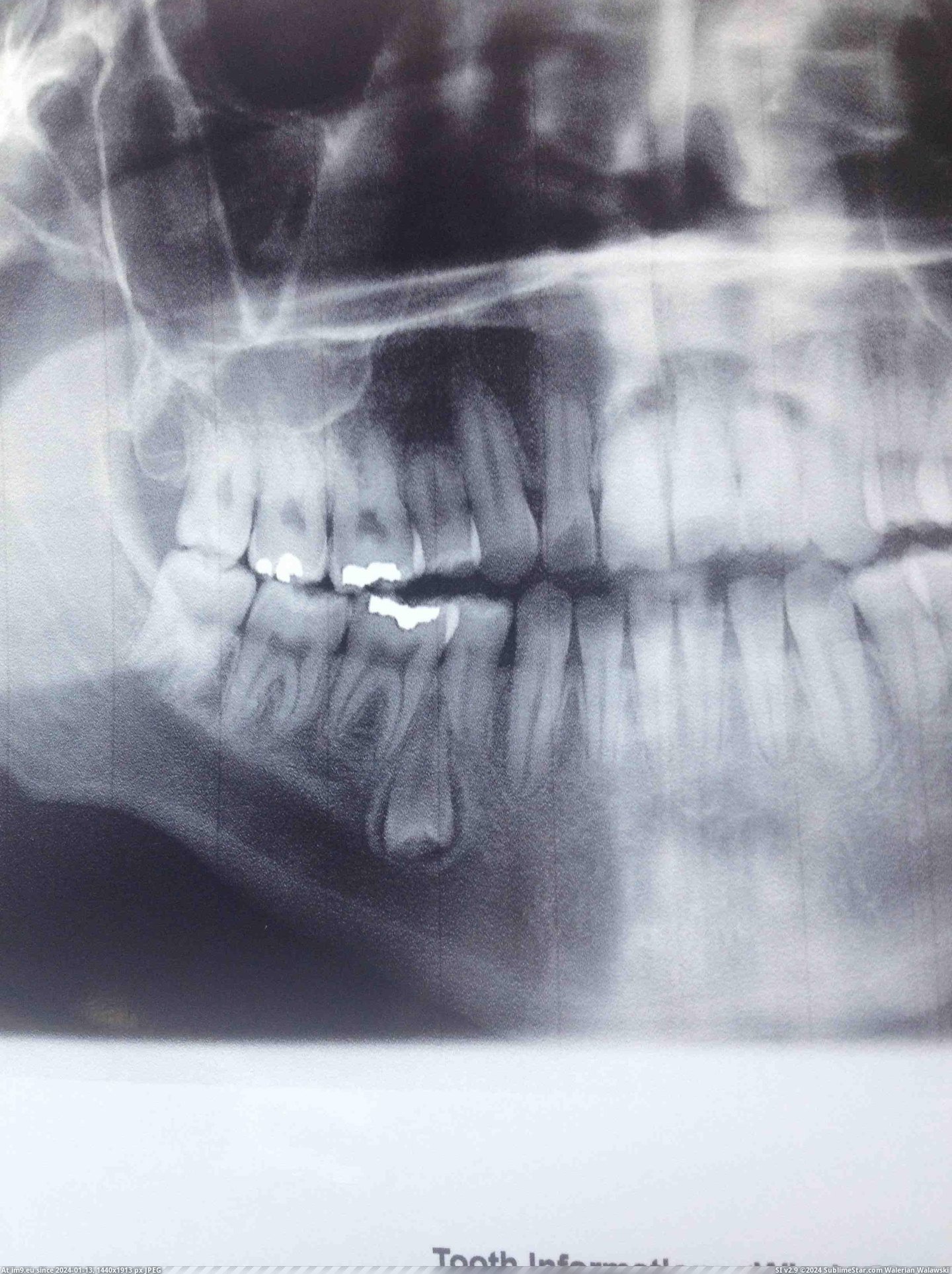 #Wtf #Growing #Tooth #Dentist #Gums #Upside #Discovered [Wtf] Went to the Dentist yesterday, they discovered a tooth growing upside down in my gums. Pic. (Obraz z album My r/WTF favs))