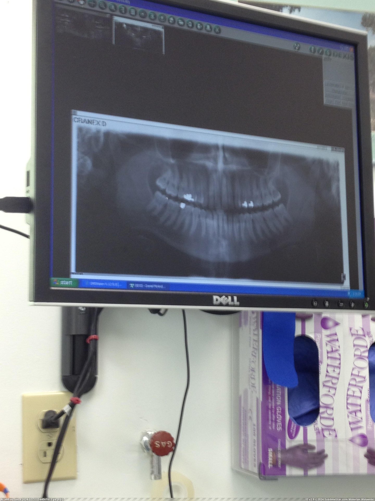 #Wtf #Day #Wrong #Wisdom #Icu #Woke #Surgery #Teeth [Wtf] Wisdom teeth surgery gone wrong. Woke up next day in ICU. 3 Pic. (Bild von album My r/WTF favs))